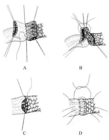 图11-13 胰肠端端套入式吻合②胰肠端侧套入式吻合:若胰体宽厚,而胰管