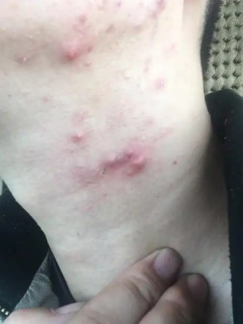 脖子上总是这个地方起痘……这到底是不是亲春痘?