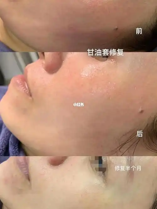 禾壹净甘油套皮脂膜修复18天效果