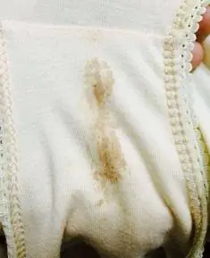 怀孕初期有褐色分泌物怎么办这些信号可能是疾病