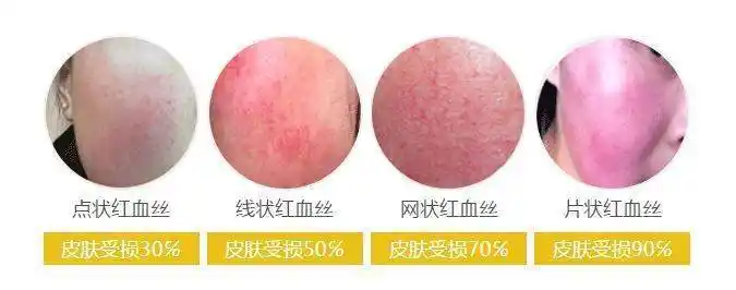 面部红血丝问题究竟出现在哪有哪些办法可以改善