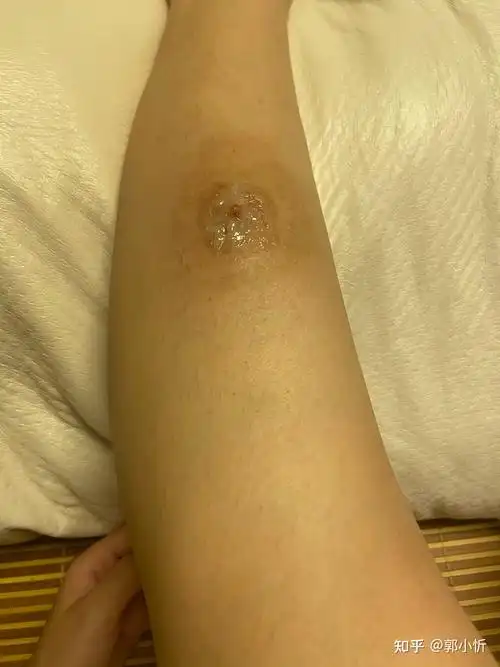 小腿火疖子从发展到切开全过程记录