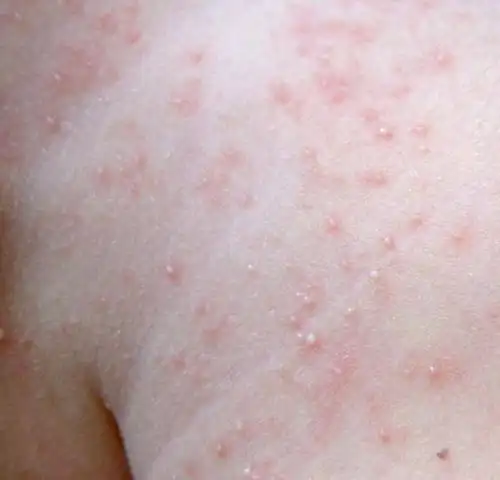 搔抓后可致继发感染引起毛囊炎,疖肿.