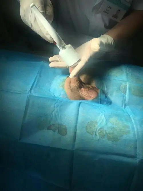 实图一一包皮环切1