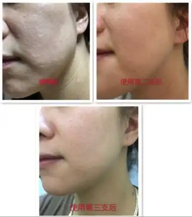 毛孔粗大?不存在的,3支就能还你一张少女颜