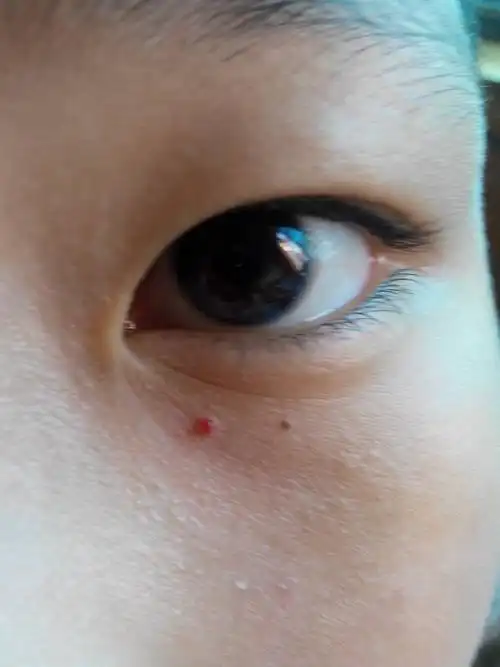 我儿子眼睛下面长了一颗红色的豆豆!现在好像比前段时间大了一点点!