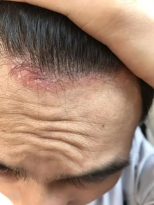 头皮问题 瘙痒掉屑_百度知道