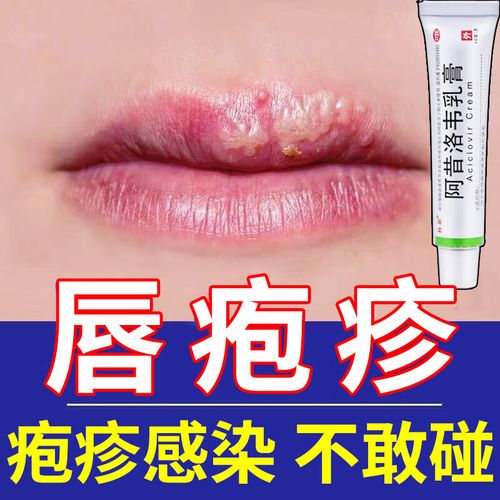 烂嘴角药 阿昔洛韦乳膏 疱疹感染引起的口角炎烂嘴角上火起泡嘴巴脓疮