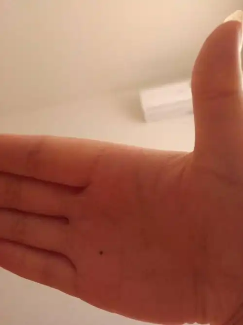 右手掌心突然长了一颗痣