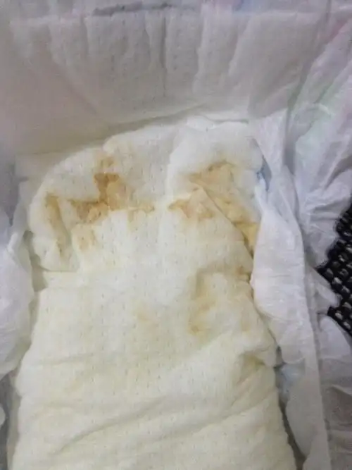 男宝宝的尿不湿是有像咖啡渍一样的水渍是怎么了