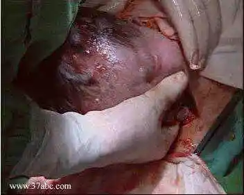 顺产,剖腹产,女人选哪个(很恶心,不喜勿喷)