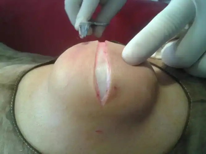 超大的皮脂腺囊肿