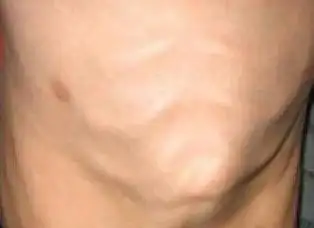 鸡胸是什么样的图片(鸡胸和正常人区别)