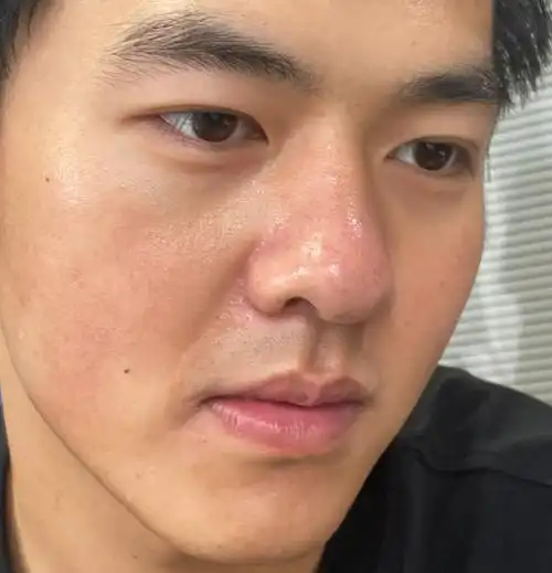 1,皮肤暗沉,暗黄