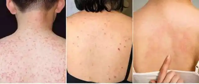 背上长疙瘩一瓶除螨沐浴露帮你赶走螨虫