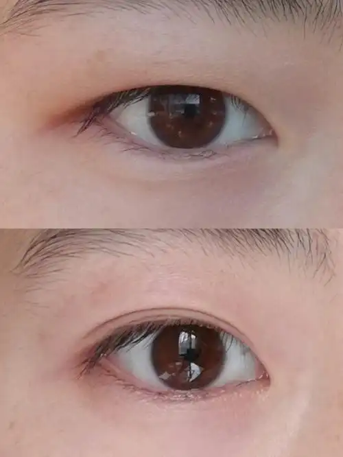 单眼皮变小内双一点也不难