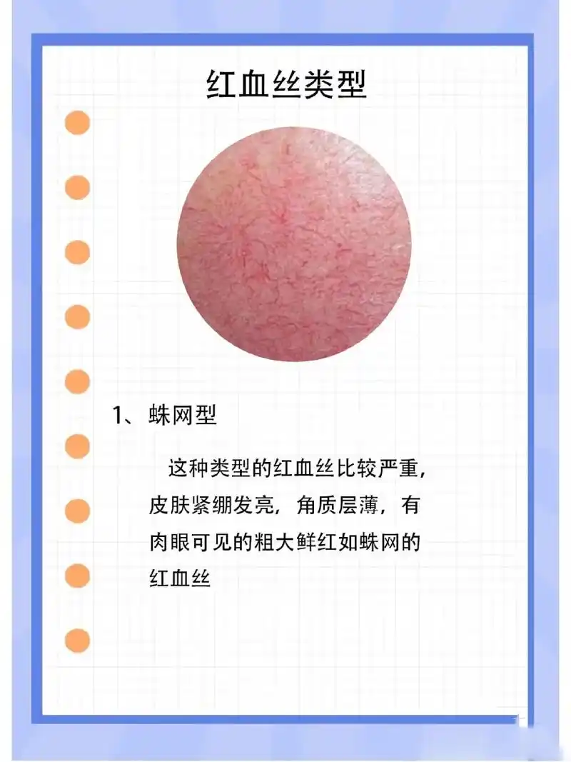 让我看看你是哪种红血丝吧!敏感肌必看!大红脸的姐妹有救了 - 抖音