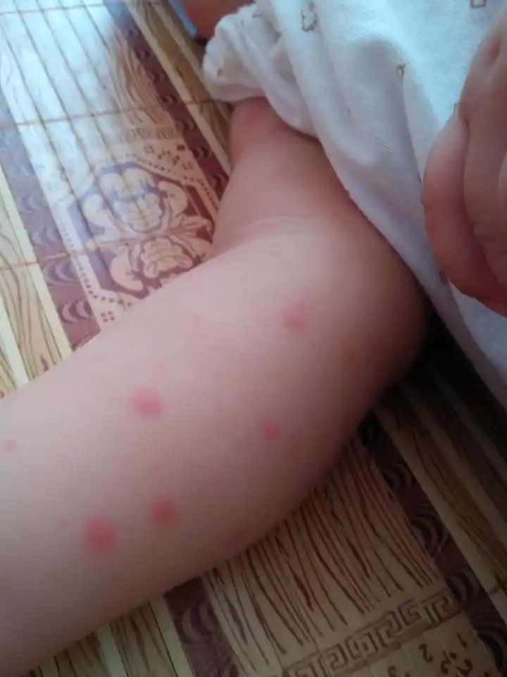 天气太热,宝宝手上突然出现好多小红点,有什么药擦吗?