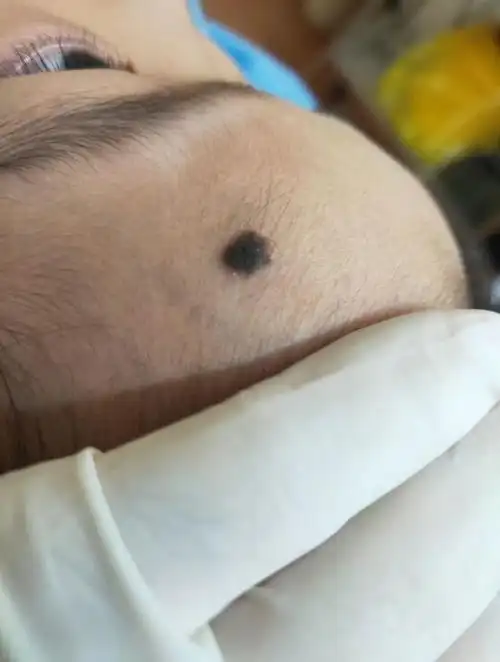 5岁女孩 额头 黑毛痣