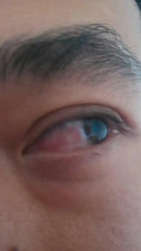 左眼,眼睛带血丝,发红,什么原因?