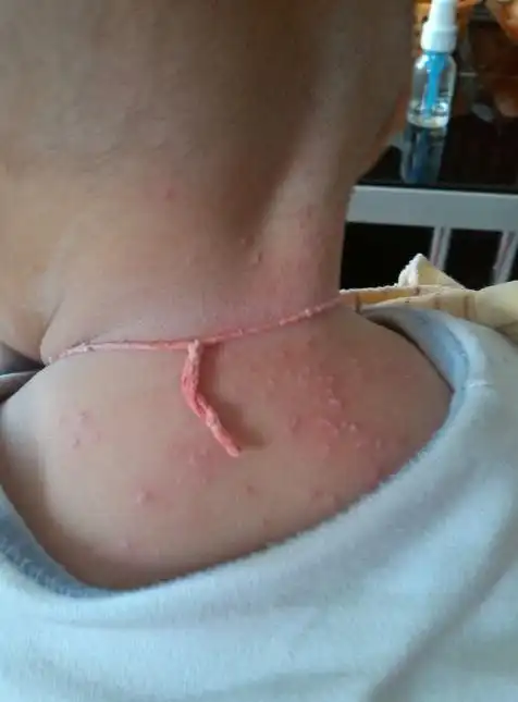 夏天稍不注意易得常见病系列:起痱子