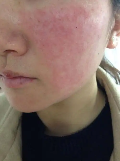 使用相宜本草的护肤品之后,皮肤过敏,烦死了,有可以缓解治疗的办法吗?