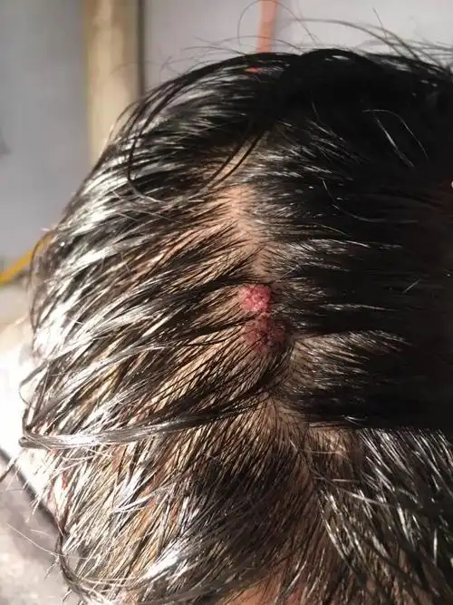 大概一个多月前头皮上长了两个小颗粒当时大概只有下图中的十分