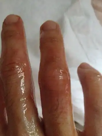 被开水烫伤手指第三天,涂了京万红药膏后,不痛了也没有起水泡,但是