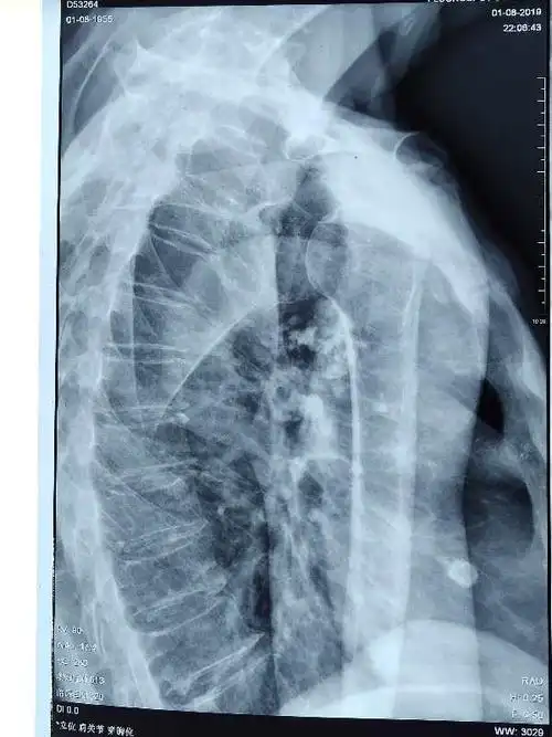 一例肩关节前脱位手法复位