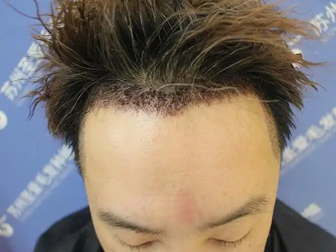 鬓角的生发效果很好啊,而且我感觉鬓角的头发长的比之_圈子-新氧美容