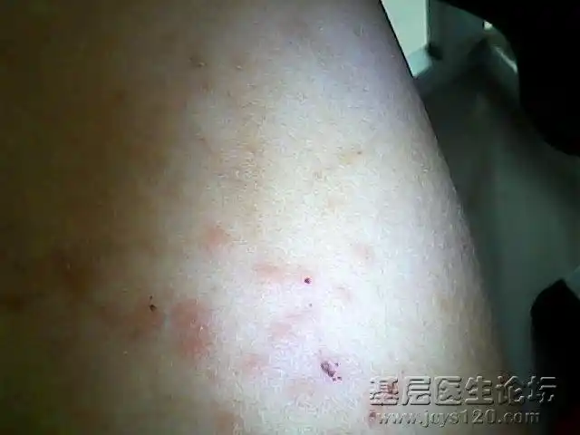 新接一例麦毒致小腿局部皮肤过敏