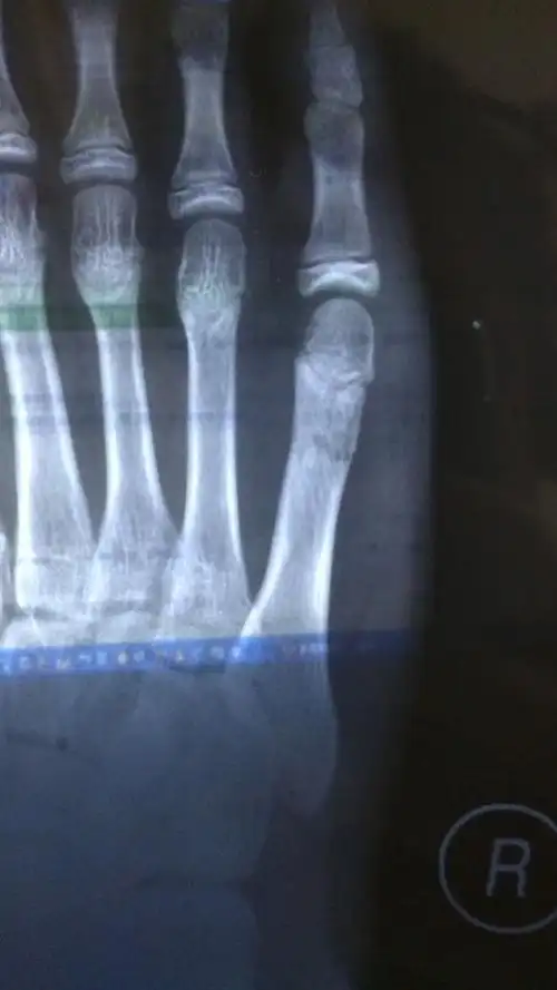 12岁初一,右脚趾骨骨折,已经打了12天石膏,25天复诊时能不能拆了,这样