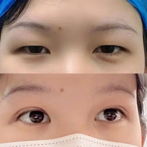 埋线双眼皮