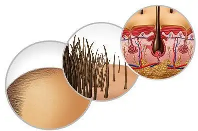 「广州皮肤科医院」身上总是长毛囊炎,要注意这些事项!