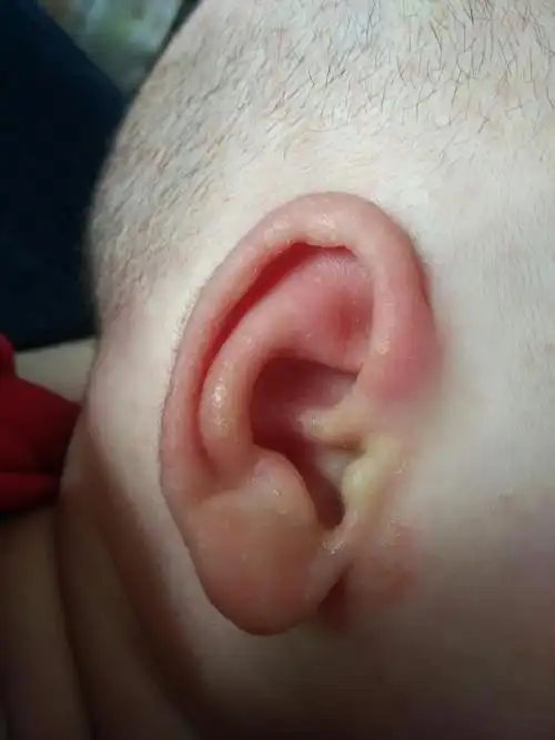 宝宝耳朵怎么了