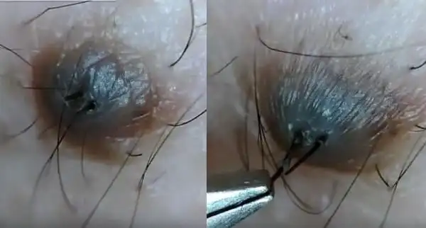 为什麼痣上长毛?到底能不能拔?