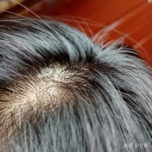 见过的最大头皮屑多大