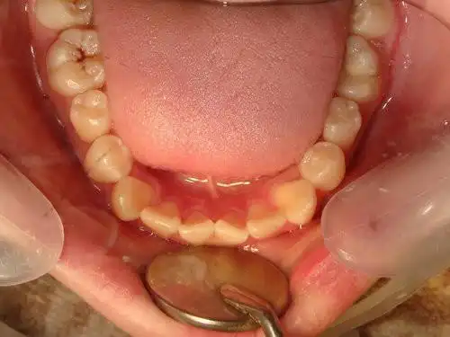 first premolar transposition(双侧上颚犬齿与第一小臼齿异位)