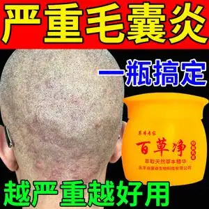 头皮毛囊炎专用药头痒有疙瘩头部头上长痘痘脓包红肿私处痤疮药膏