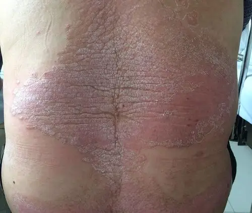 【典型病例】ha280血液灌流疗程化治疗寻常型银屑病(红斑型)1例