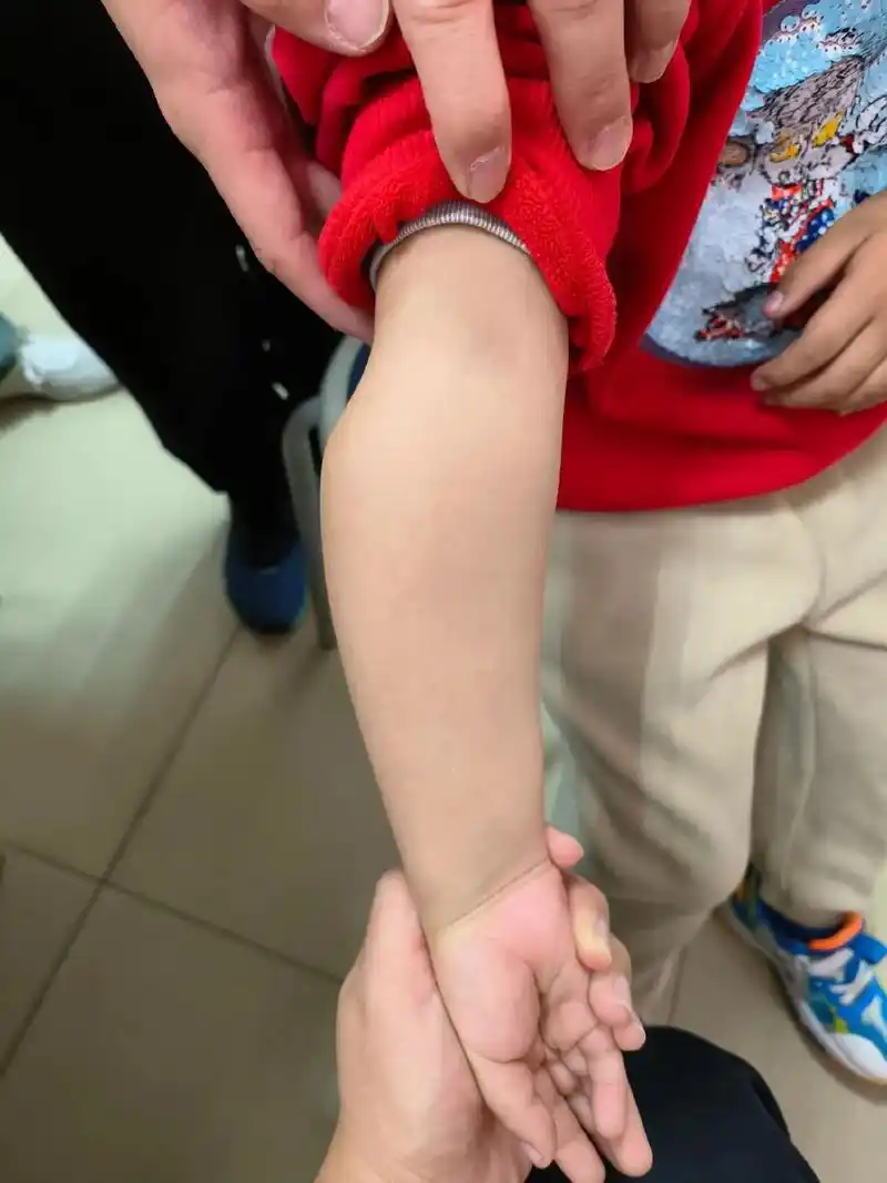 还是骨软骨瘤病导致肢体畸形.