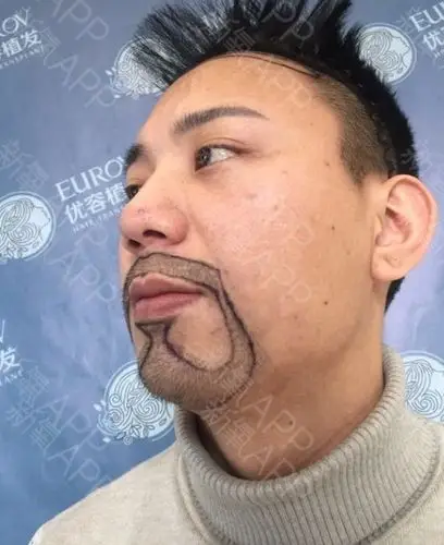 看到德美的优容植发这边有艺术植胡须这个项目,又特地上门和