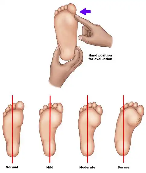 孩子走路内八字外八字,到底需不需要矫正,妈妈们看这一篇就够了