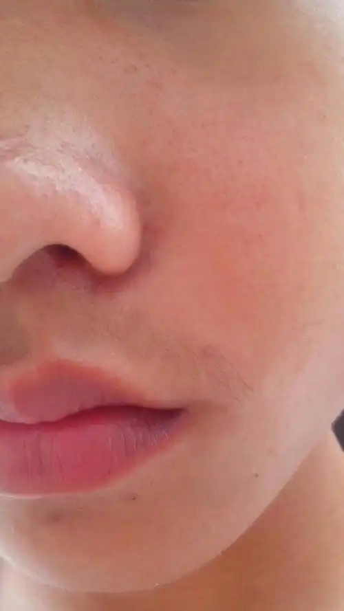 本人17,鼻头有好多黑头,而且毛孔大,经常出油,还有u区的毛孔也大,还长