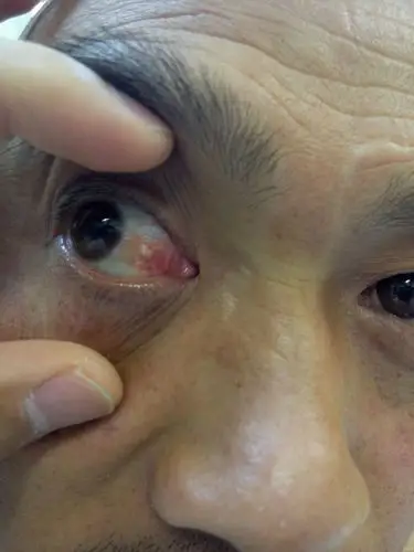 求助:泡性结膜炎吗