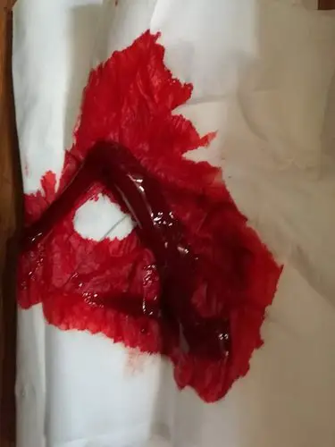 患者身上排出的血毒