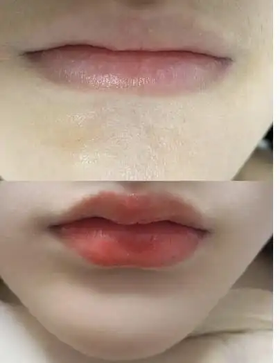 玻尿酸嘟嘟唇对比照片_整形达人问答