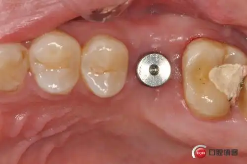 一例后牙即刻种植修复与瓷嵌体修复