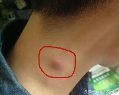 颈部淋巴结肿大症状(颈部淋巴结肿大不可大意)