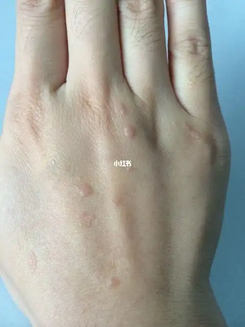 扁平疣_维生素b6_补充维生素_维生素c_维生素_维a酸乳膏_医疗健康